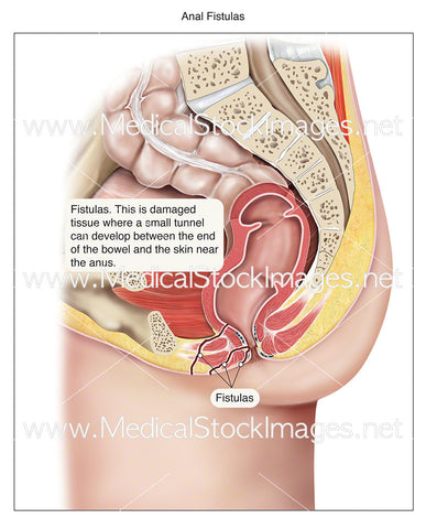 Anal Fistulas - Labelled