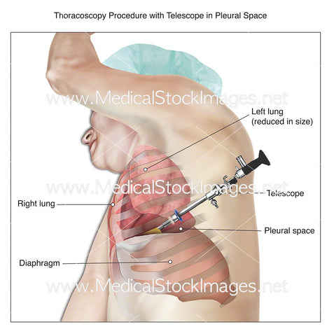 Thoracoscopy Procedure with Telescope in Pleural Space