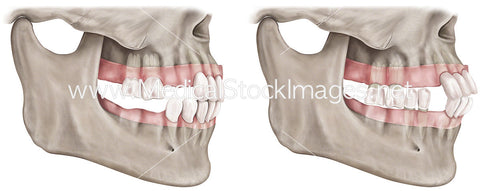 Dental Illustration Depicting Tooth Loss
