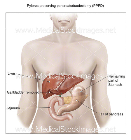 Pylorus Preserving Pancreatoduodectomy (PPPD)