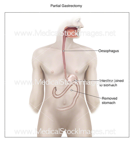Partial Gastrectomy - Labelled