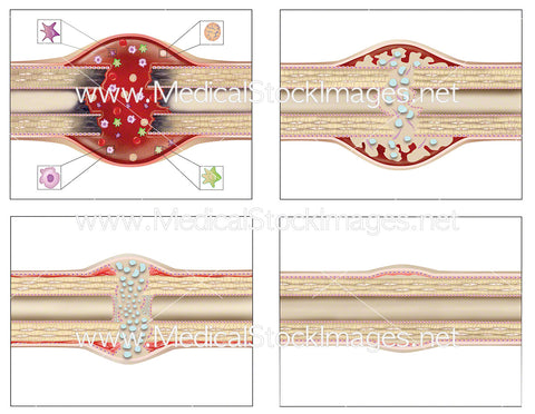 Bone Healing Stages