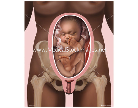 Baby in a Vertex Posterior Position