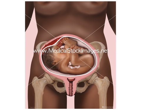 Birth with Baby in a Transverse Lie Position