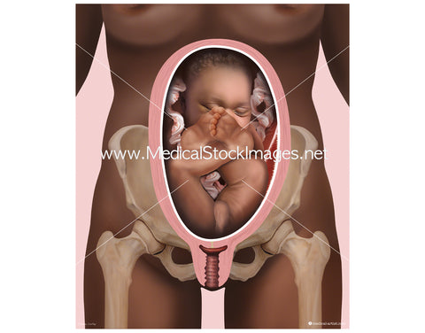 Birth and the Frank Breech Position