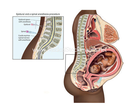 Epidural and Spinal Procedure Illustration Figure of an African-American Woman