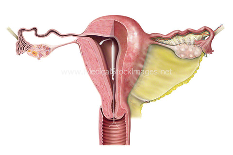 IUD Placed within the Uterus
