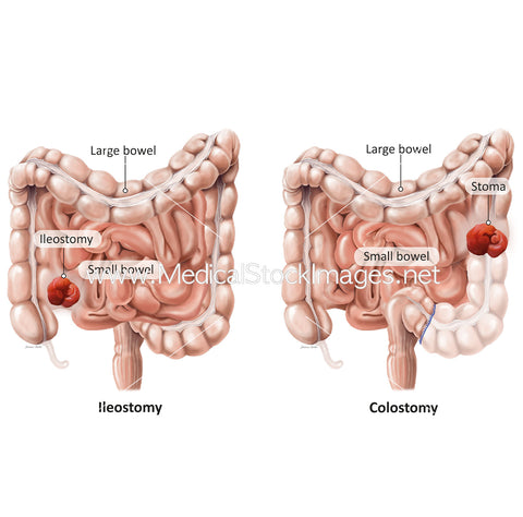 Anatomy of Ileostomy and Colostomy