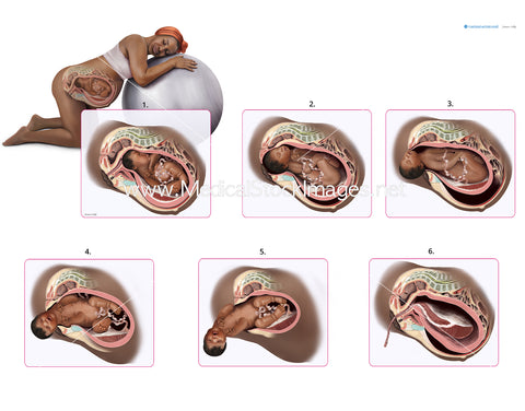 Labour Birth Stages using a Birthing Ball (Birth ball) - (African Heritage).