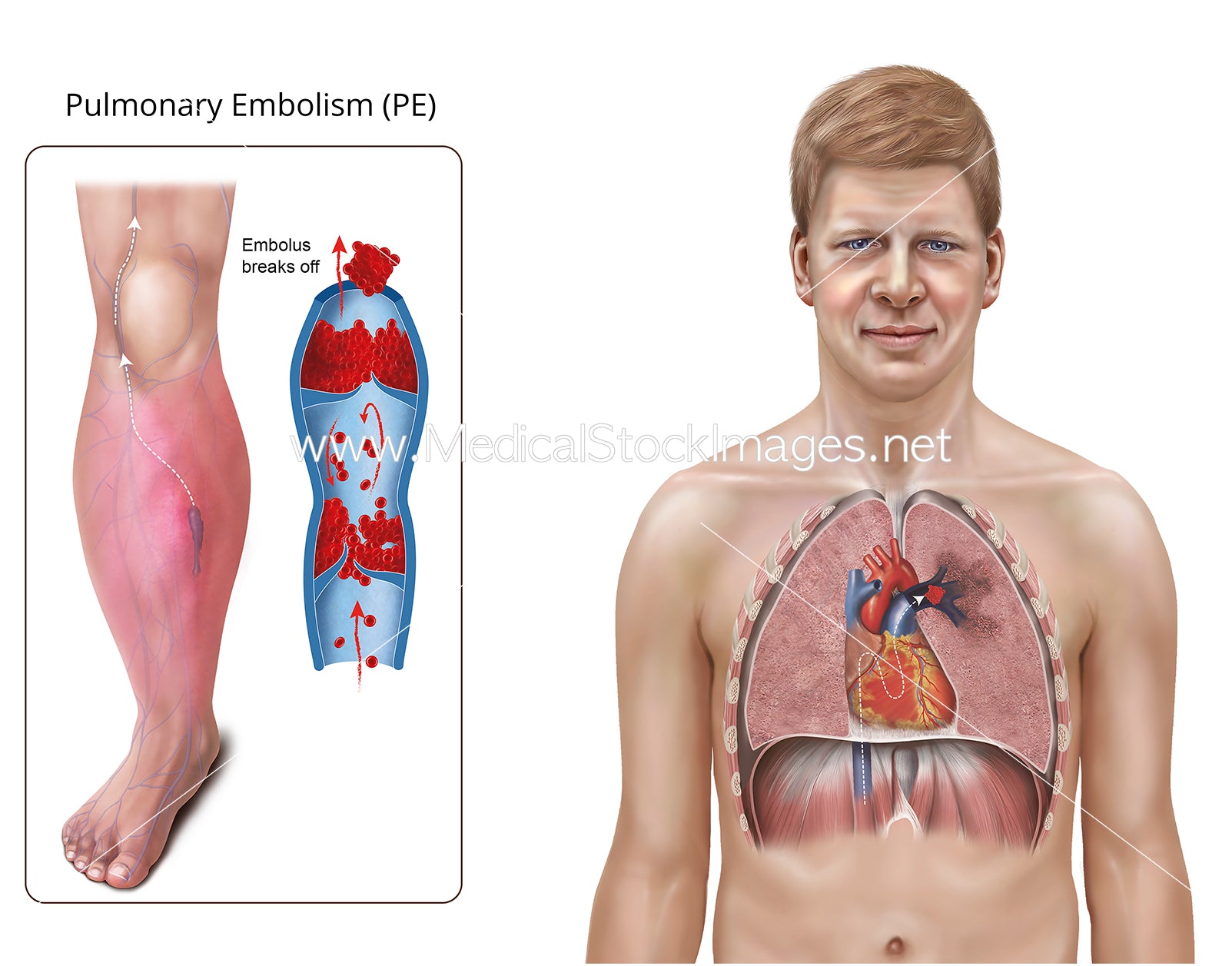 Large Emboli Pulmonary Embolism (PE) Explainer Illustration – Medical Stock Images ...