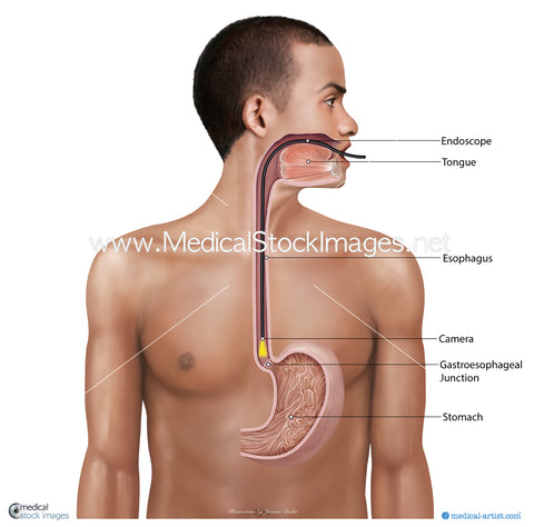 An esophageal junction camera illustration - Labelled