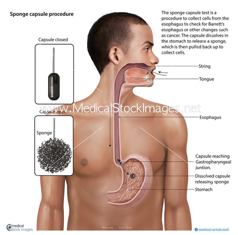 Illustration of a Sponge Capsule Procedure - Labelled