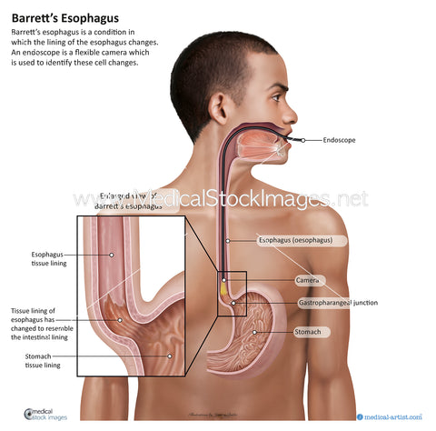 Illustration of Barratt's Esophagus (Esophagus) - South America Figure - Labelled