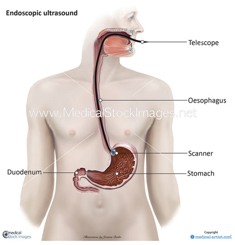 Endoscopic ultrasound - Labelled