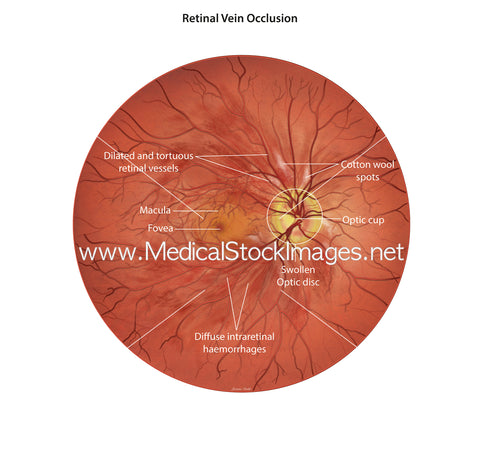 Illustration of a Retinal Vein Occlusion (RVO) Fundoscopy