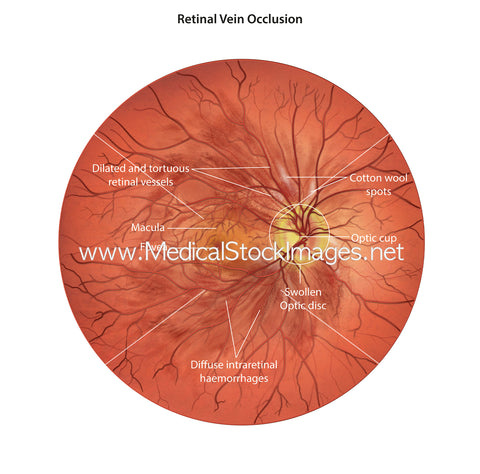 Illustration of a Retinal Vein Occlusion (RVO) Fundoscopy