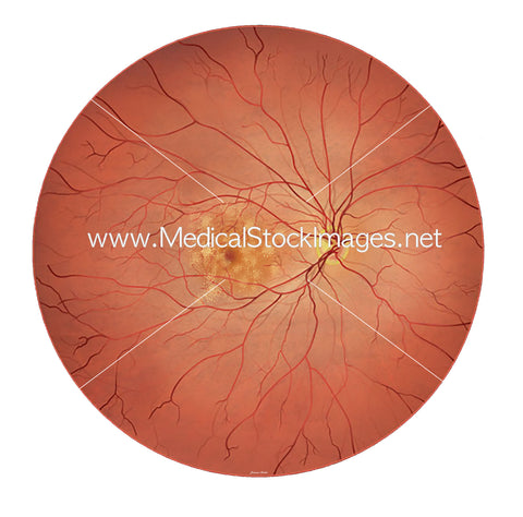 Illustration of DRY Age Related Macular Degeneration (AMD)