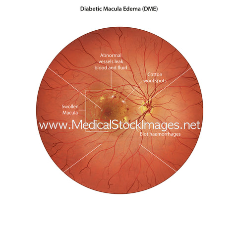 Illustration of Diabetic Macular Edema (DME)-Labelled