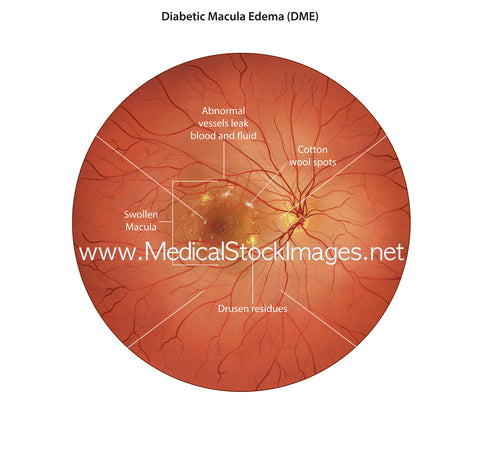Illustration of Diabetic Macular Edema (DME)-Labelled