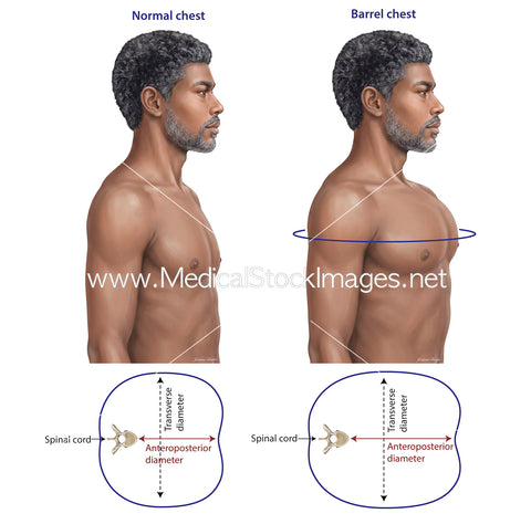Anatomical Change of a Barrel Chest versus Normal Chest