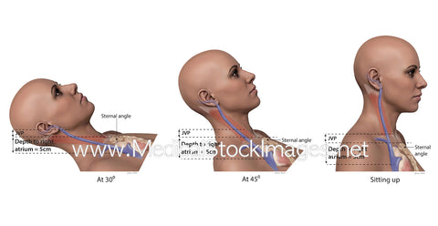 Effect of Changing Height of the Jugular Venous Pressure (JVP)