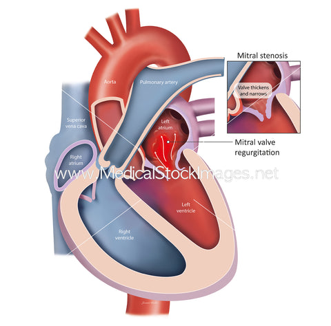 Heart Mitral Valve Disorder