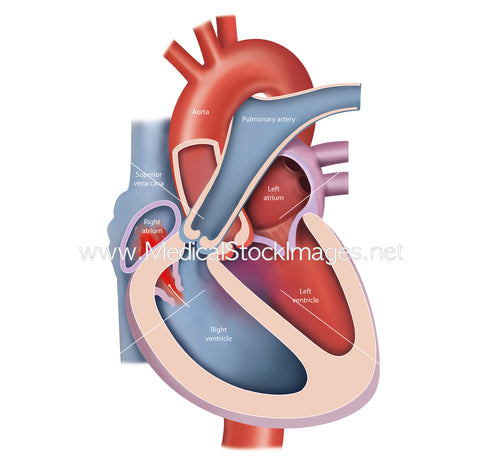 Heart Tricuspid Valve Disorder