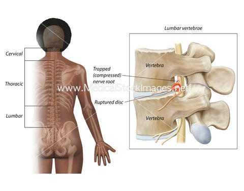 Side View of Bulging Disc-Lumbar Region