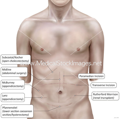 Surface Anatomy of Common Operative Scars