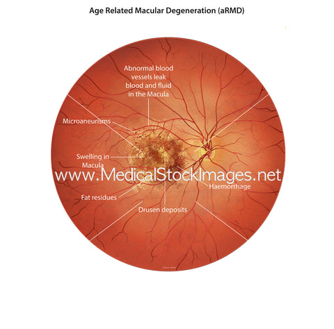 Age Related Macular Degeneration (AMD) Fundoscopy Illustration