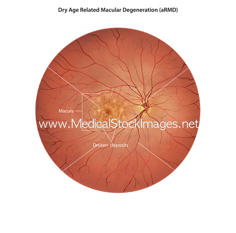 Labelled Illustration of DRY Age Related Macular Degeneration (AMD)