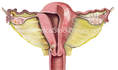 Uterus Cross-Section with Tumour