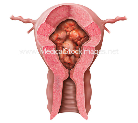 Hyperplasia Multiple Polyps in Uterus