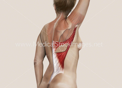 Latissimus Dorsi or Myocutaneous (LD) Flap Surgery No Labels