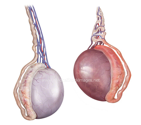 Healthy Testicle Compared to Torsion of the Testicle