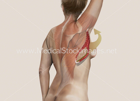 Latissimus Dorsi or Myocutaneous (LD) Flap Surgery Step 2