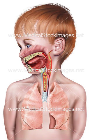 Young Boy with Croup Showing Respiratory Tract in Cross-Section