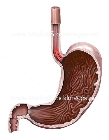 Esophagus & Stomach Showing Mallory Weiss Tear