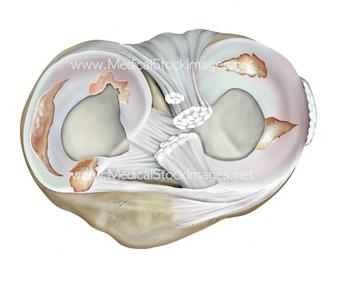 Superior View of Tears in the Meniscus of the Knee
