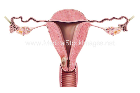 Uterus Shown With Tumour