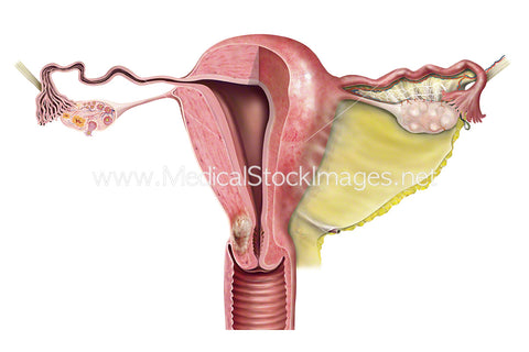 Uterus Shown as Half Cross Section with Tumour