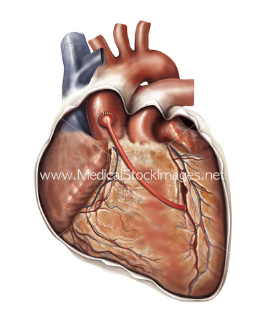 Illustration Showing a Coronary Artery Bypass Graft or CABG