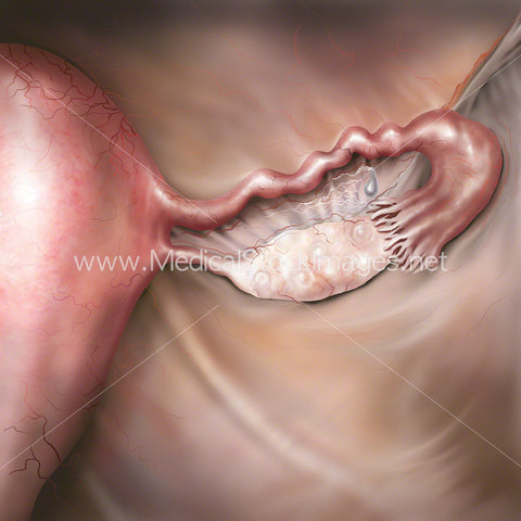 Ovary and Fallopian Tube