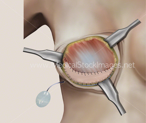 Illustration of the Third Stage of Breast Surgery involving Soft Tissue Support