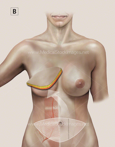 Breast Reconstruction called Transverse Rectus Abdominus (TRAM FLAP) No labels.