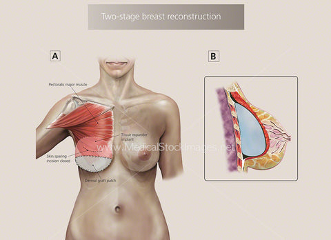 Illustration of Two Stages of Breast Reconstruction
