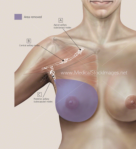 Total Mastectomy Colour Background