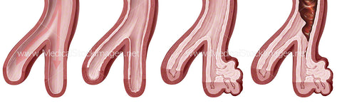 Pulmonary Hypertension