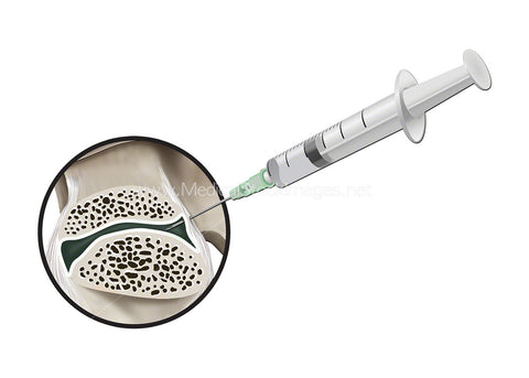 Injection into the Facet Joint of the Lumbar Vertebra