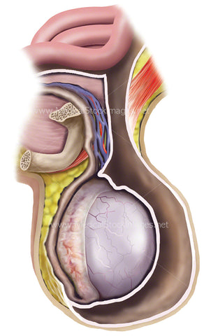 Hydrocele of the Testicle